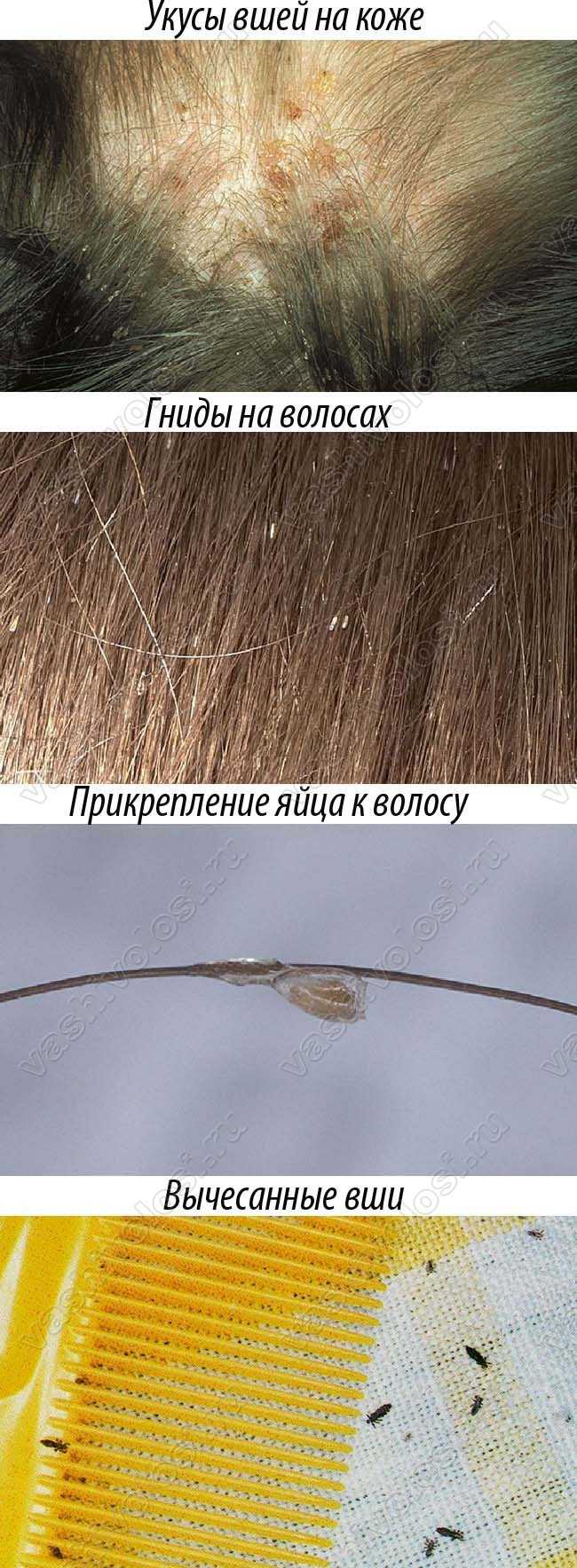 Как Выглядят Вши На Волосах Фото