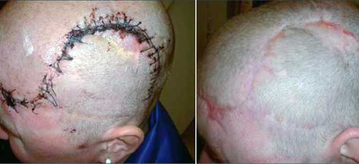 Лечение рубцовой алопеции на коже головы