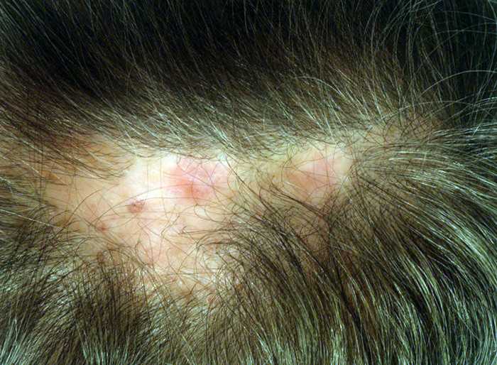 Лечение рубцовой алопеции на коже головы