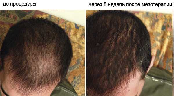 Мезотерапия для роста волос с помощью кислорода