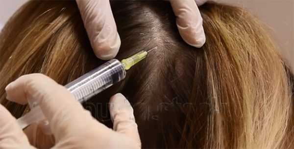 Мезотерапия для роста волос с помощью кислорода