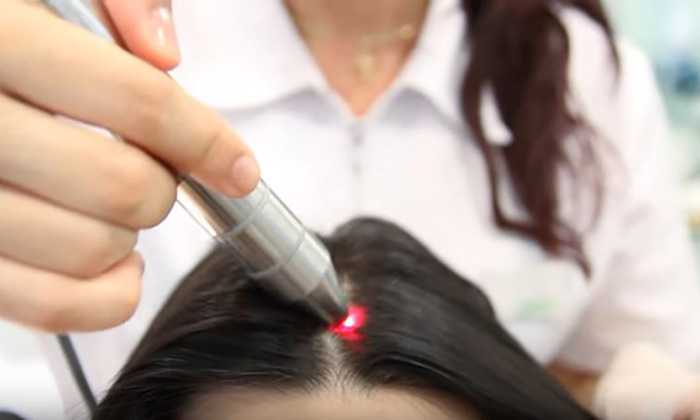 Низкоуровневая лазерная терапия от выпадения волос