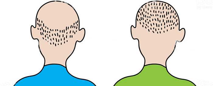 Разница между выпадением волос в 20 и 60 лет