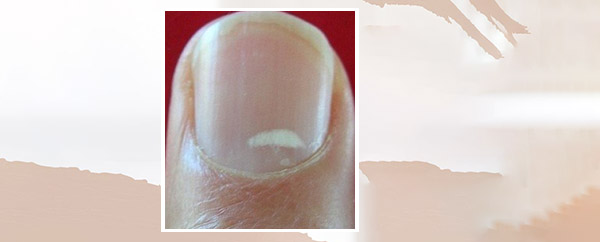 На какое заболевание указывают белые пятна на ногтях?